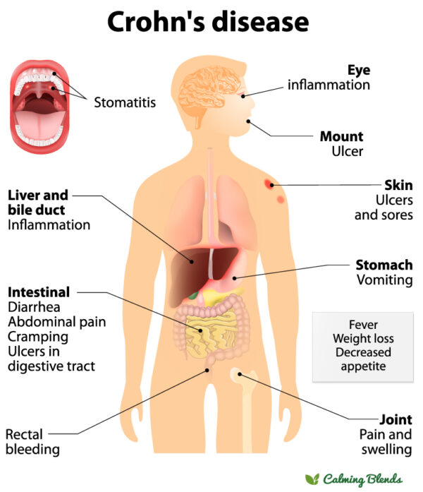 Crohns-Disease-Diagram