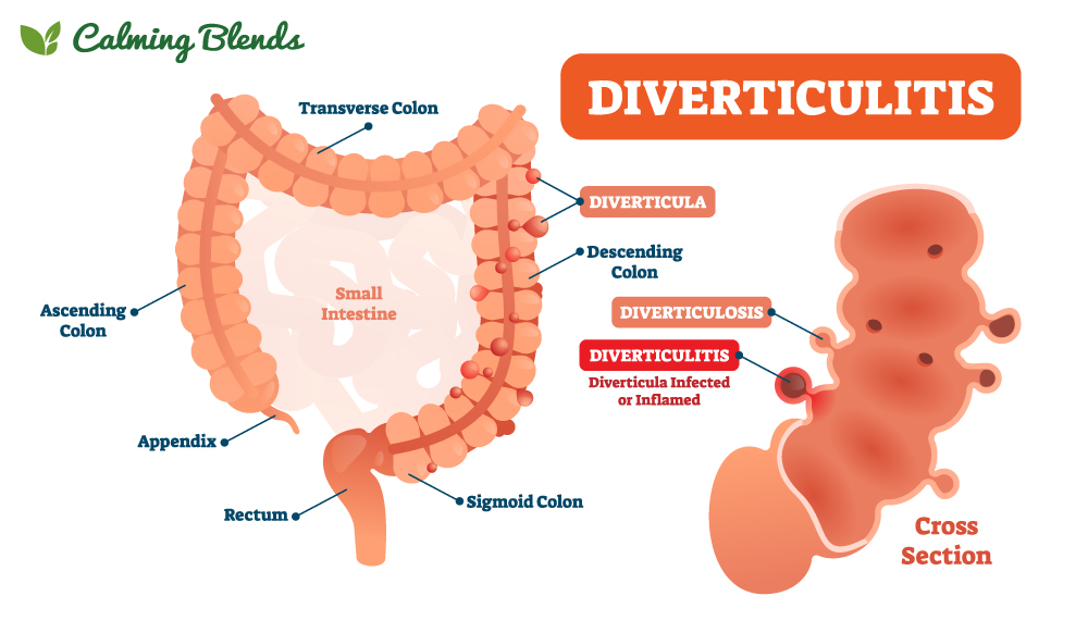 Diverticulitis-Diagram