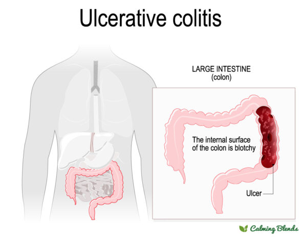 Ulcerative Colitis Diagram